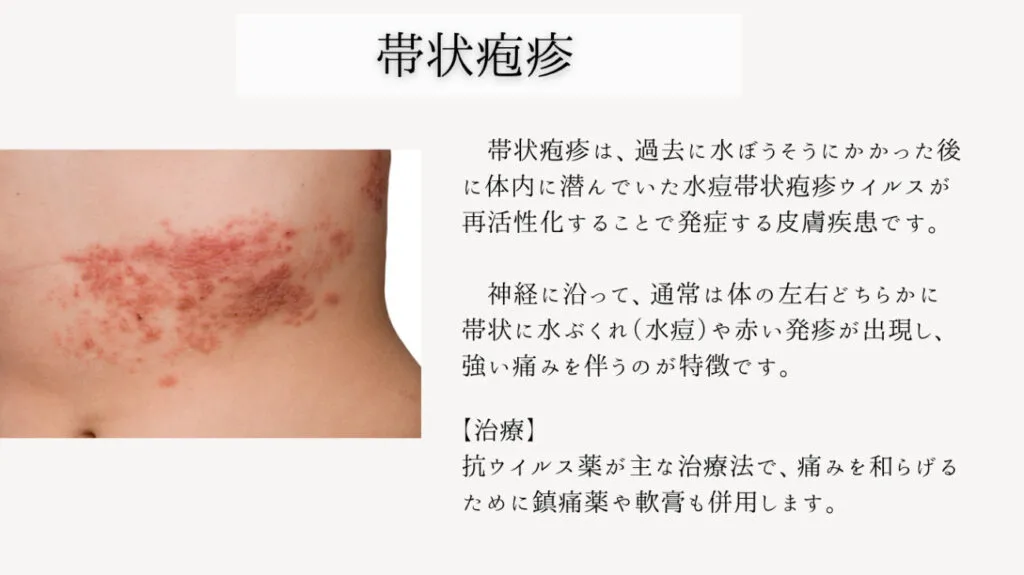 帯状疱疹