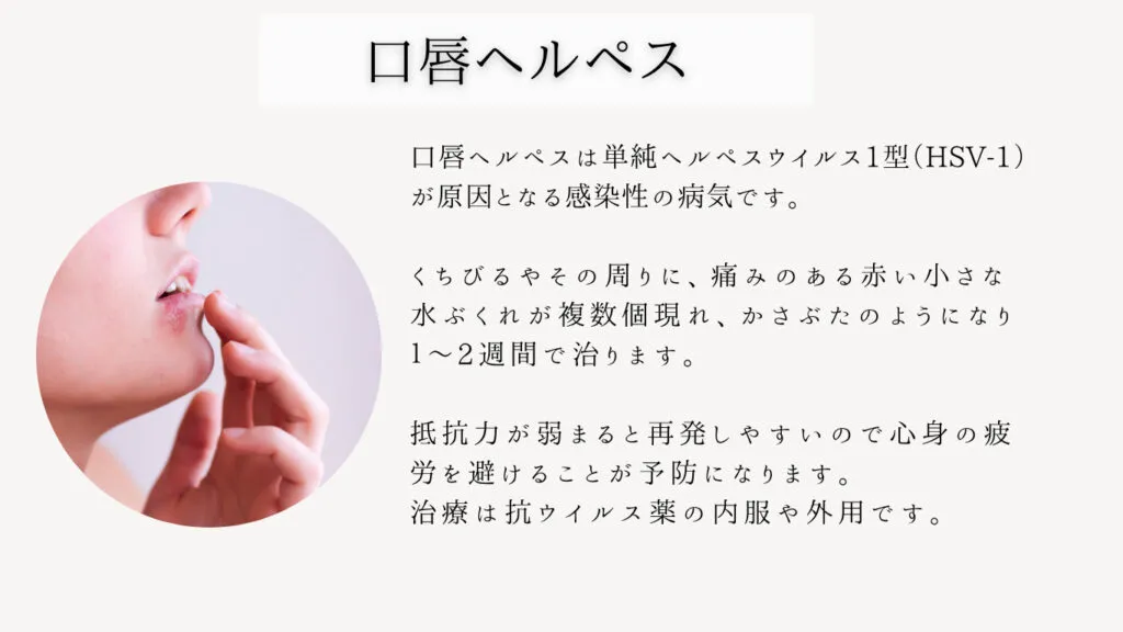 口唇ヘルペス