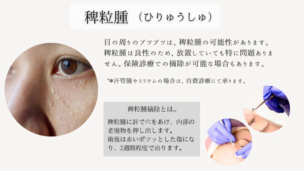 稗粒腫(ひりゅうしゅ)