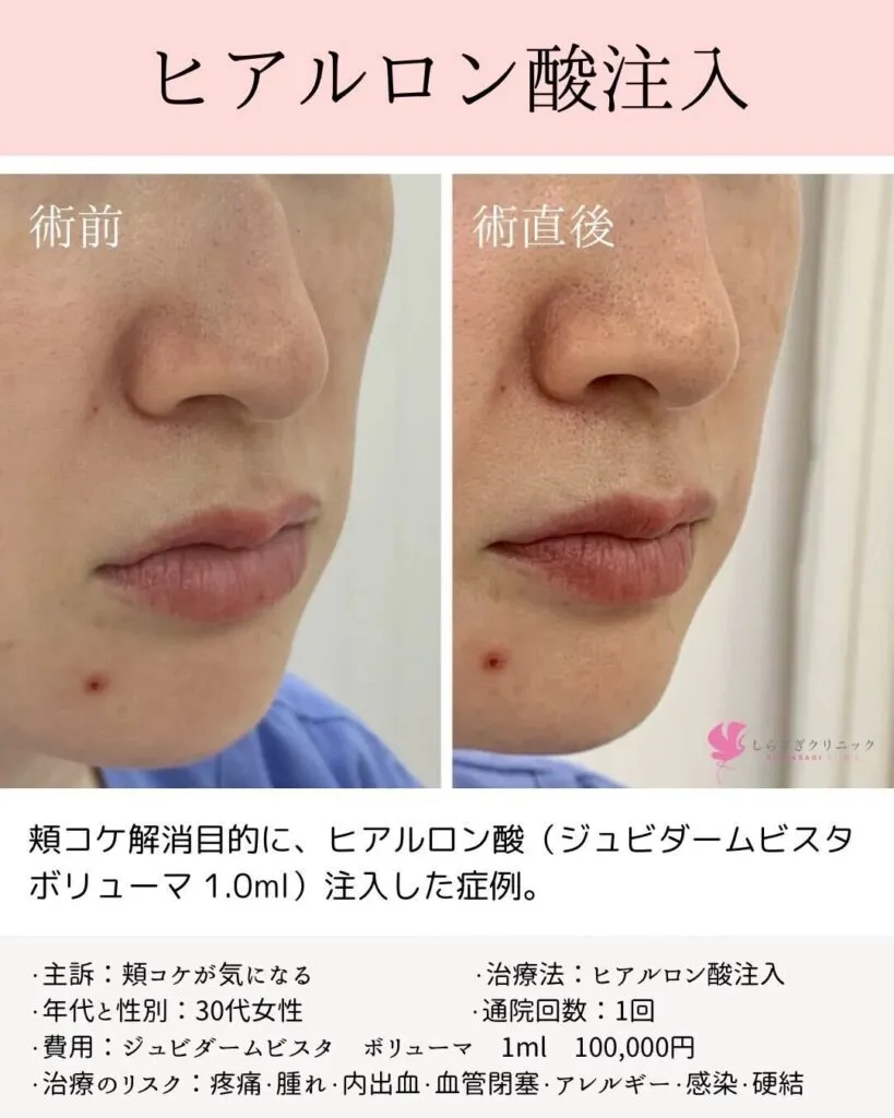 ヒアルロン酸注入