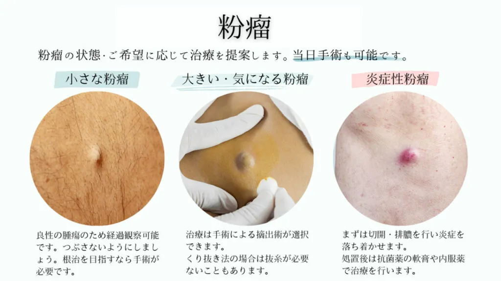 粉瘤