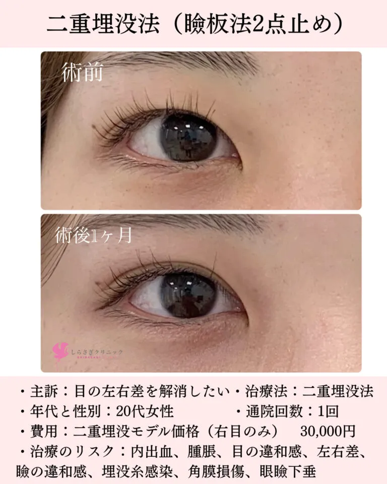 女性右目のみ二重