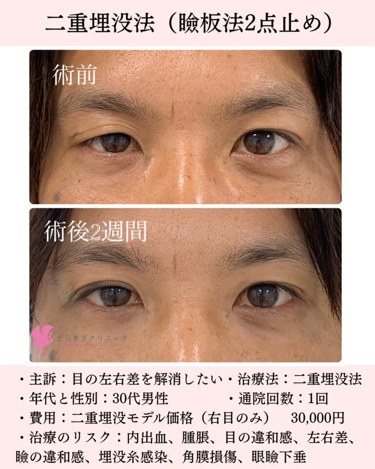 男性右目のみ二重